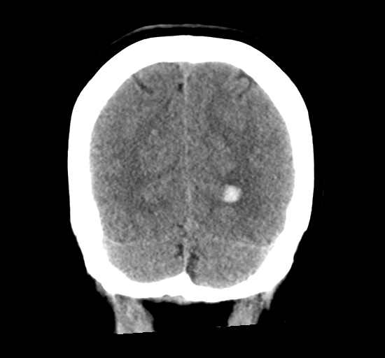 File:Arteriovenous malformation (cerebral) (Radiopaedia 40070-42579 Coronal non-contrast 32).png