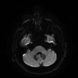 File:Artery of Percheron infarct (Radiopaedia 48088-52928 Axial DWI 9).jpg