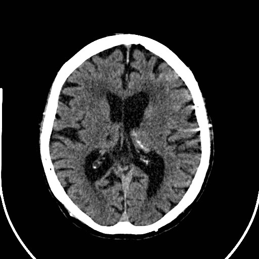 File:Artery of Percheron infarction (Radiopaedia 26307-26438 Axial non-contrast 25).jpg