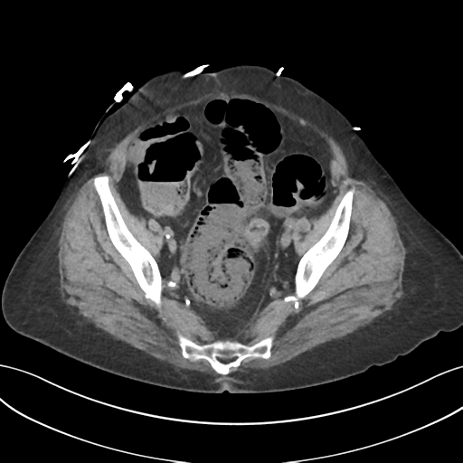 File:Ascending cholangitis (Radiopaedia 39068-41253 Axial non-contrast 54).png