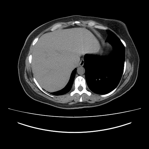Ascending retrocecal appendicitis with liver abscesses (Radiopaedia 60066-67615 Axial non-contrast 11).jpg