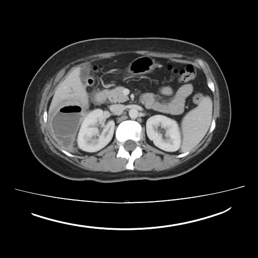 Ascending retrocecal appendicitis with liver abscesses (Radiopaedia 60066-67615 B 35).jpg
