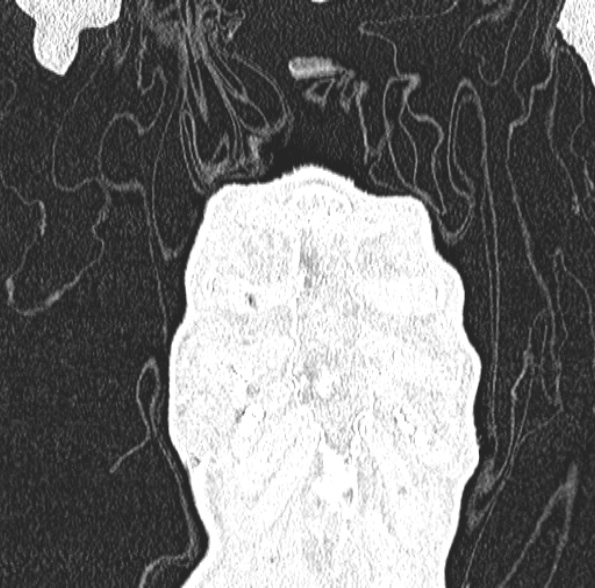 Aspergilloma- with Monod sign (Radiopaedia 44737-48532 Coronal lung window 118).jpg