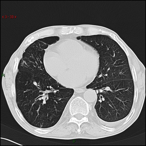 File:Aspergilloma (Radiopaedia 14842-14787 Axial lung window 30).jpg