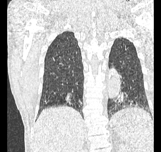 Aspergilloma (Radiopaedia 44592-48327 Coronal lung window 103).jpg