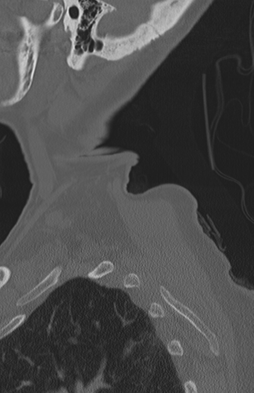 Atlanto-axial subluxation (Radiopaedia 36610-38176 Sagittal bone window 7).png