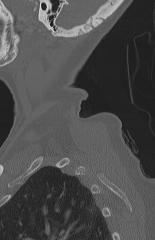 Atlanto-axial subluxation (Radiopaedia 36610-38176 Sagittal bone window 9).png
