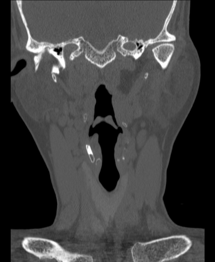 Atlanto-occipital assimilation with basilar invagination (Radiopaedia 70122-80188 Coronal bone window 21).jpg