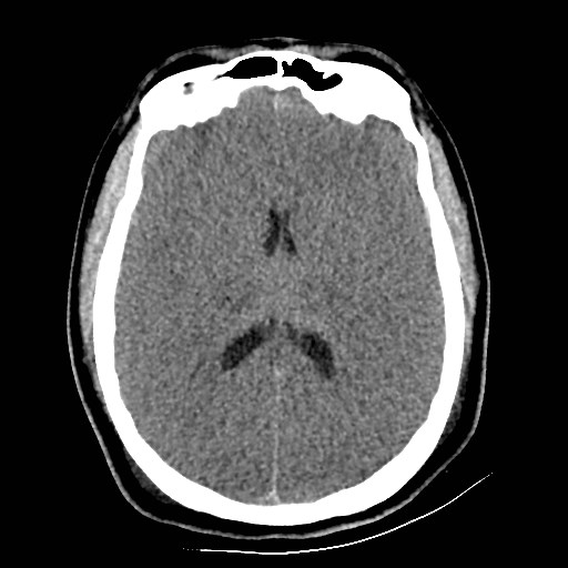 Atlanto-occipital dislocation (Radiopaedia 44648-48412 Axial non-contrast 31).jpg