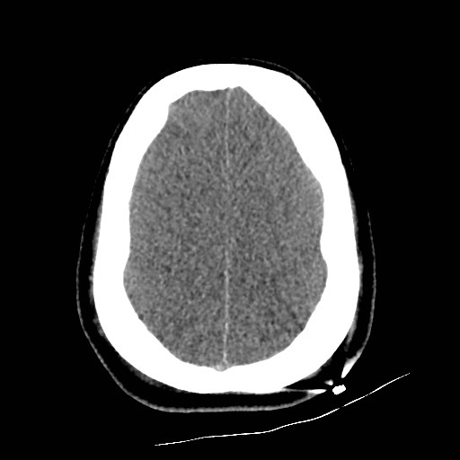 File:Atlanto-occipital dislocation (Radiopaedia 44648-48412 Axial non-contrast 44).jpg