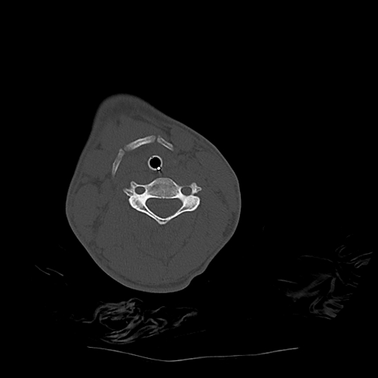 Atlanto-occipital dissociation (Traynelis type 1), C2 teardrop fracture, C6-7 facet joint dislocation (Radiopaedia 87655-104061 Axial bone window 50).jpg