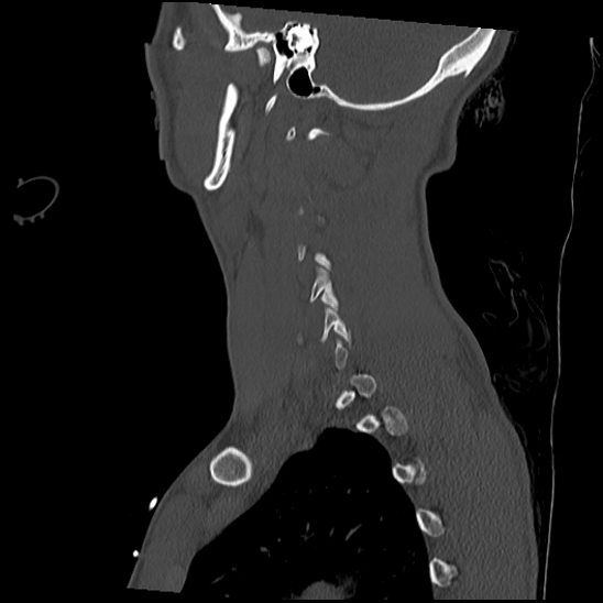 Atlanto-occipital dissociation (Traynelis type 1), C2 teardrop fracture, C6-7 facet joint dislocation (Radiopaedia 87655-104061 Sagittal bone window 52).jpg