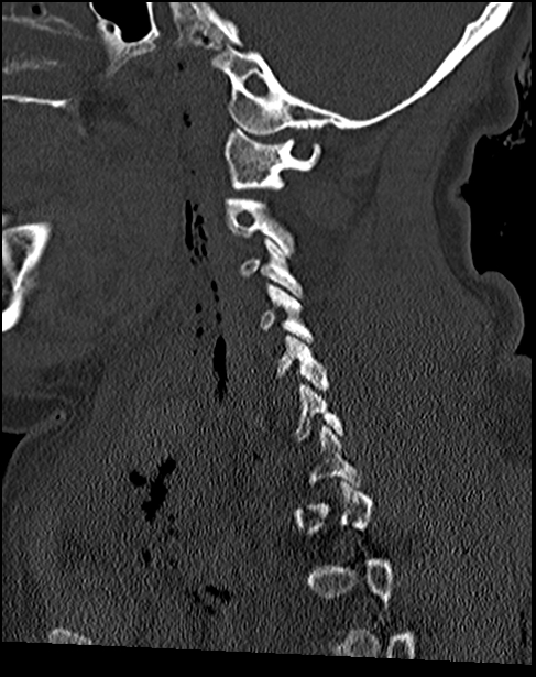 Atlanto-occipital dissociation - Traynelis type 1 (Radiopaedia 87570-103948 Sagittal bone window 36).jpg
