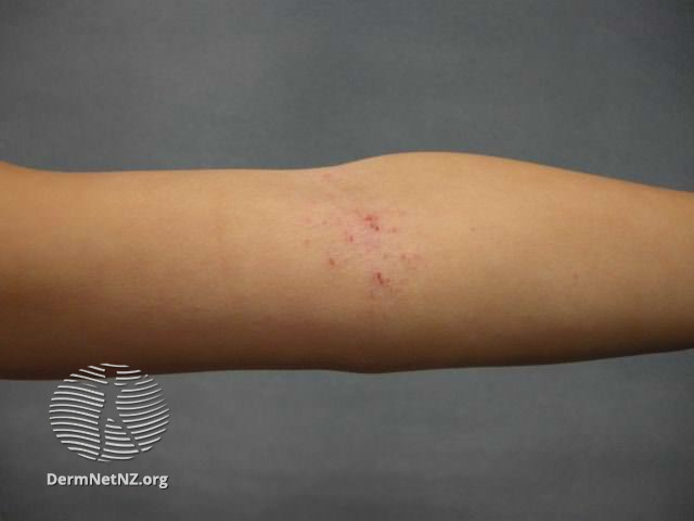 File:Atopic dermatitis (DermNet NZ dermatitis-flexural-eczema09).jpg
