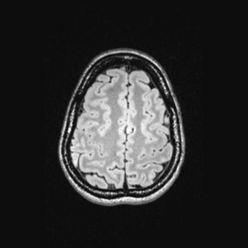 Atretic encephalocoele with inferior vermis hypoplasia (Radiopaedia 30443-31108 Axial 125).jpg