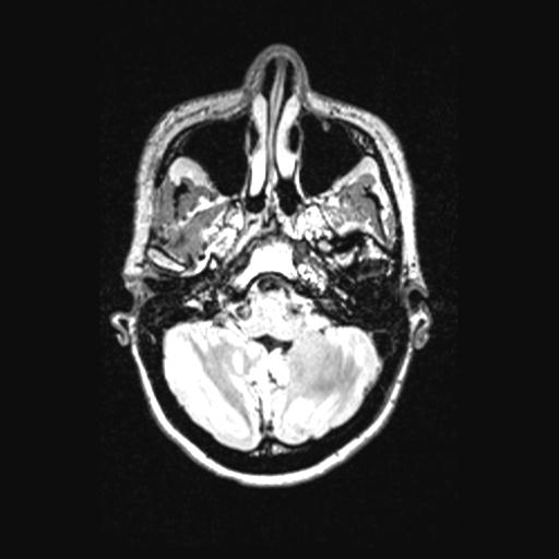 Atretic encephalocoele with inferior vermis hypoplasia (Radiopaedia 30443-31108 Axial 39).jpg