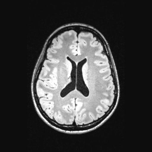 Atretic encephalocoele with inferior vermis hypoplasia (Radiopaedia 30443-31108 Axial 96).jpg