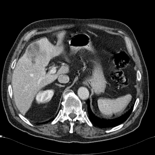 Atypical hepatocellular carcinoma (Radiopaedia 41744-44698 B 21).jpg