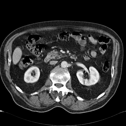 Atypical hepatocellular carcinoma (Radiopaedia 41744-44698 B 43).jpg