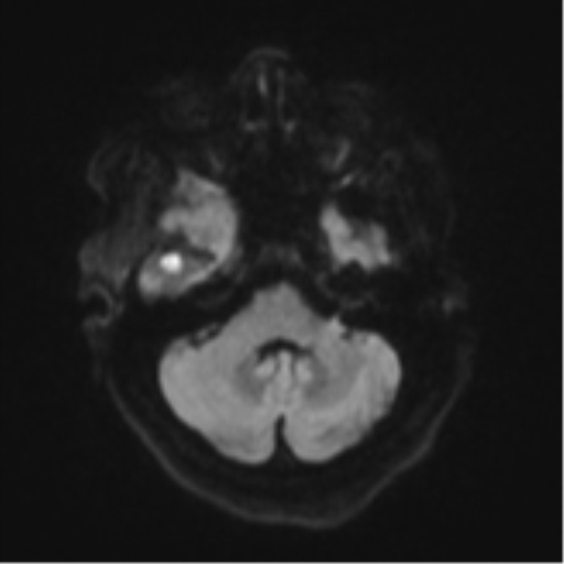 File:Atypical meningioma (WHO Grade II) (Radiopaedia 54742-60981 Axial DWI 35).png