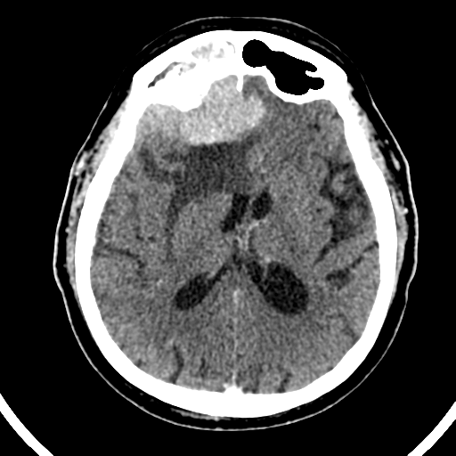 File:Atypical meningioma (WHO grade II) with brain invasion (Radiopaedia 57767-64728 Axial C+ 27).png