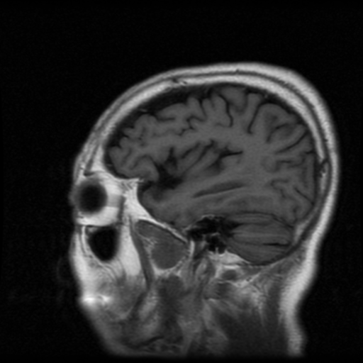 File:Atypical meningioma (WHO grade II) with osseous invasion (Radiopaedia 53654-59716 Sagittal T1 6).png