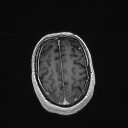 Atypical meningioma (grade II) - en plaque (Radiopaedia 29633-30147 Axial T1 C+ 148).jpg