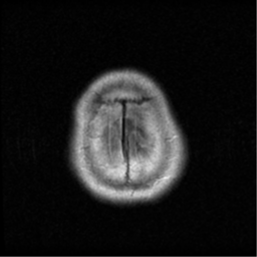 File:Atypical meningioma with skull invasion (Radiopaedia 34357-35648 Axial FLAIR 21).png