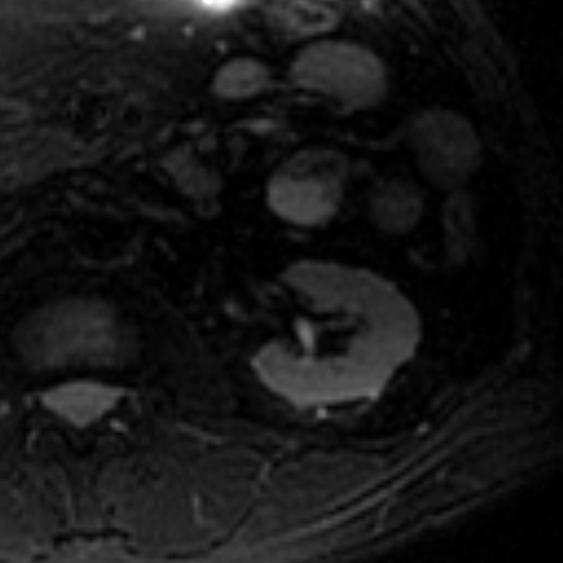 File:Atypical renal cyst on MRI (Radiopaedia 17349-17046 Axial T2 fat sat 14).jpg