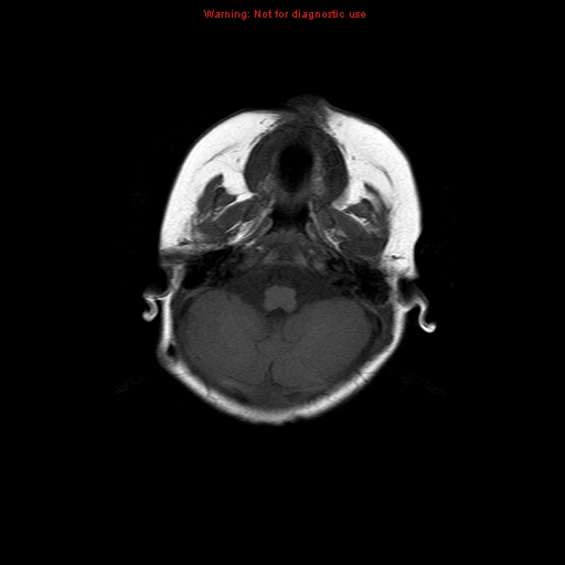 File:Atypical teratoid rhabdoid tumor (Radiopaedia 10712-11183 Axial T1 15).jpg