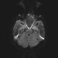 Autoimmune limbic encephalitis (Radiopaedia 30363-31005 Axial B0 and DWI 43).jpg
