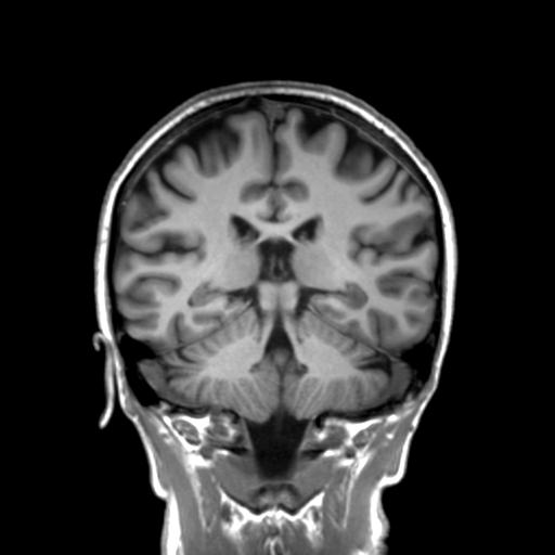 Autoimmune limbic encephalitis (Radiopaedia 30363-31005 Coronal T1 24).jpg