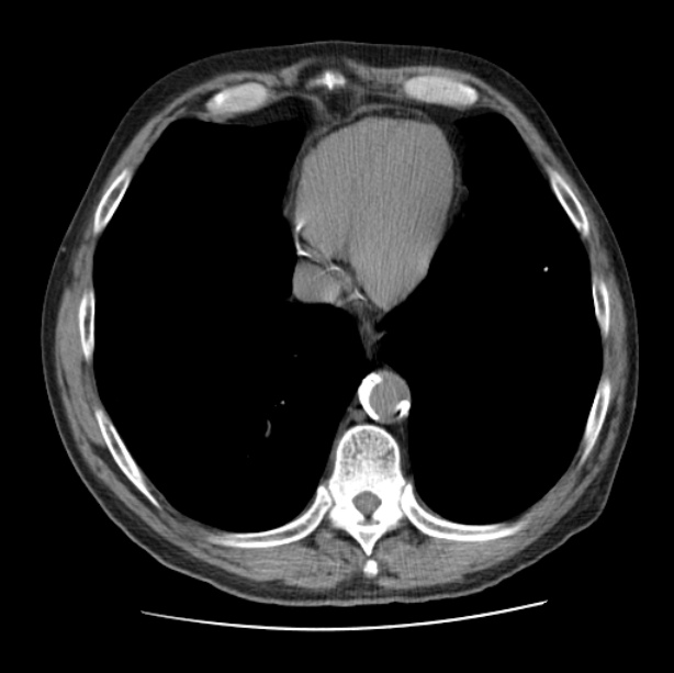 Autosomal dominant polycystic kidney disease (Radiopaedia 27851-28094 Axial non-contrast 42).jpg