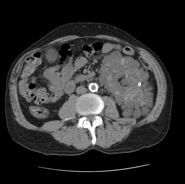 Autosomal dominant polycystic kidney disease (Radiopaedia 27851-28094 Axial non-contrast 77).jpg