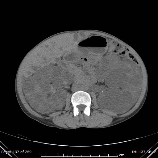 File:Autosomal dominant polycystic kidney disease (Radiopaedia 44122-47684 Axial 4).jpg