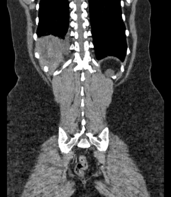 Autosomal dominant polycystic kidney disease (Radiopaedia 57124-64017 B 65).jpg