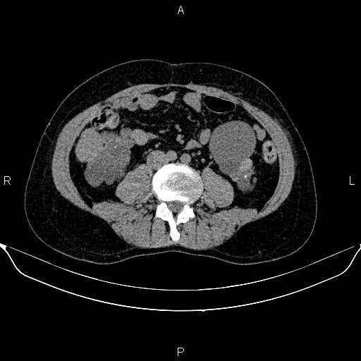 Autosomal dominant polycystic kidney disease (Radiopaedia 87830-104287 Axial non-contrast 33).jpg