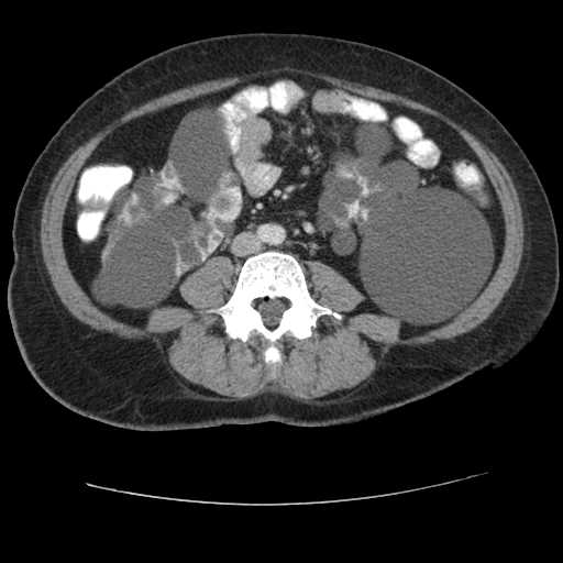 Autosomal dominant polycystic kidney disease with hepatic involvement (Radiopaedia 32693-33662 B 48).jpg
