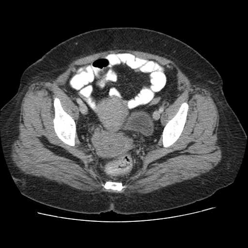 File:Autosomal dominant polycystic kidney disease with hepatic involvement (Radiopaedia 32693-33662 B 72).jpg