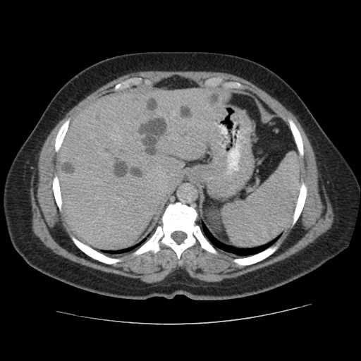 Autosomal dominant polycystic kidney disease with hepatic involvement (Radiopaedia 32693-33662 C 13).jpg