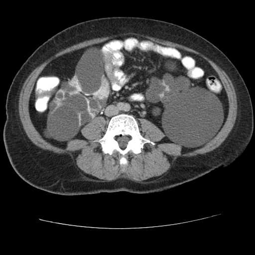 Autosomal dominant polycystic kidney disease with hepatic involvement (Radiopaedia 32693-33662 C 48).jpg