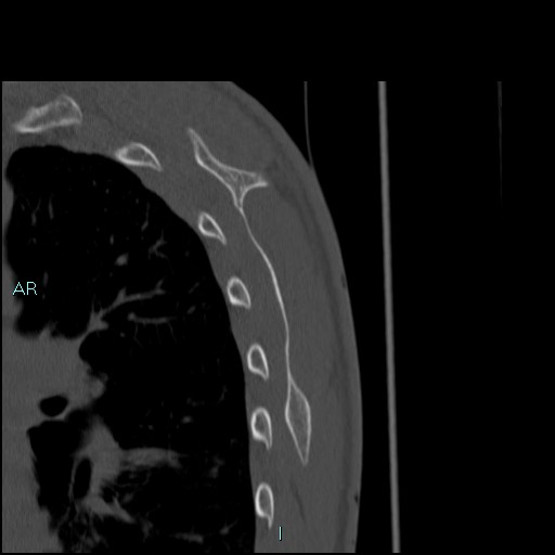 File:Avascular necrosis after fracture dislocations of the proximal humerus (Radiopaedia 88078-104653 Sagittal bone window 77).jpg