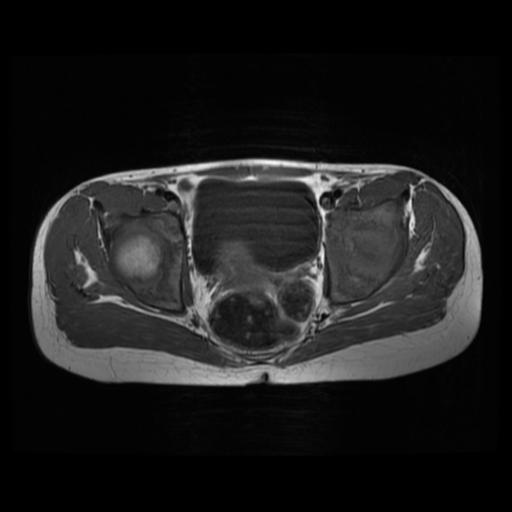 File:Avascular necrosis of the hip (Radiopaedia 29563-30067 Axial T1 4).jpg