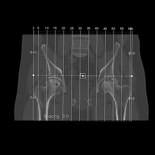 Avascular necrosis of the hip (Radiopaedia 61503-69467 B 1).jpg
