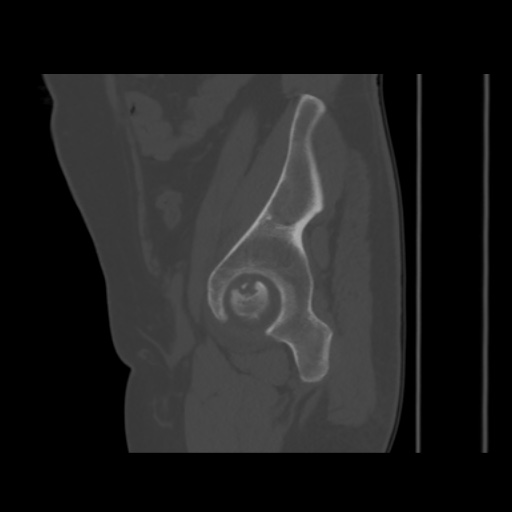 File:Avascular necrosis of the hip (Radiopaedia 61503-69467 B 44).jpg