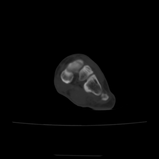 Avulsion fracture of the dorsal cuboid bone (Radiopaedia 51586-57377 Axial bone window 95).jpg