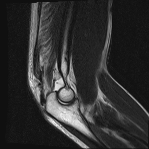 File:Avulsion of the triceps tendon (Radiopaedia 42919-46154 Sagittal T2 4).jpg