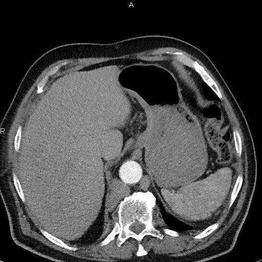 File:Azygos continuation of the inferior vena cava (Radiopaedia 18537-18404 C+ arterial phase 50).jpg