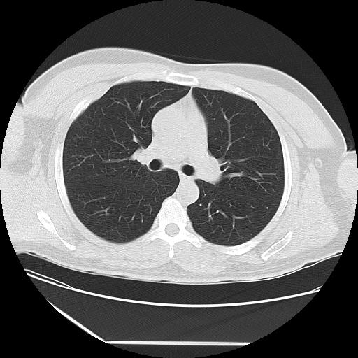 Azygos fissure (Radiopaedia 88181-104784 Axial lung window 20).jpg