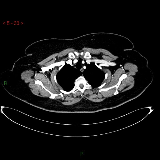 Azygos fissure and lobe (Radiopaedia 47620-52278 A 19).jpg